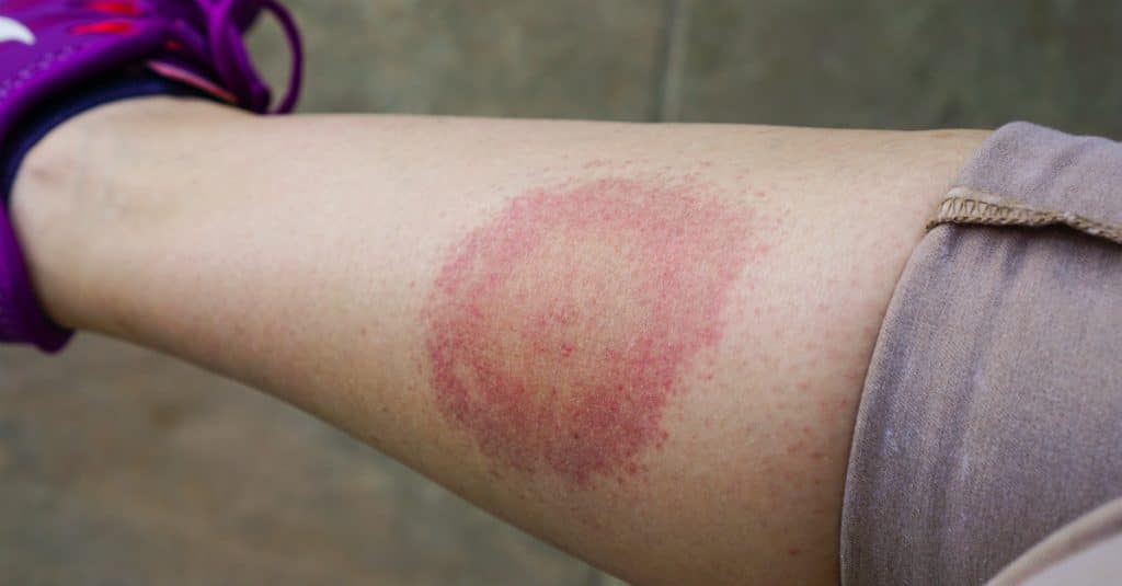 How To Avoid Dangerous Bug Encounters